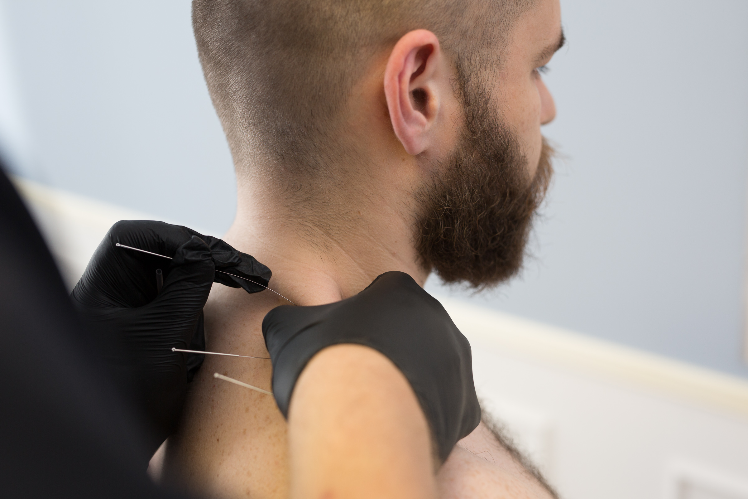 zabieg suche igłowanie wykonany przez fizjoterapeutę w gabinecie we Wrocławiu